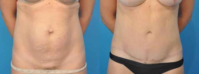 Before & After Abdominoplasty/Tummy Tuck Case 99 Front View in North Shore, IL