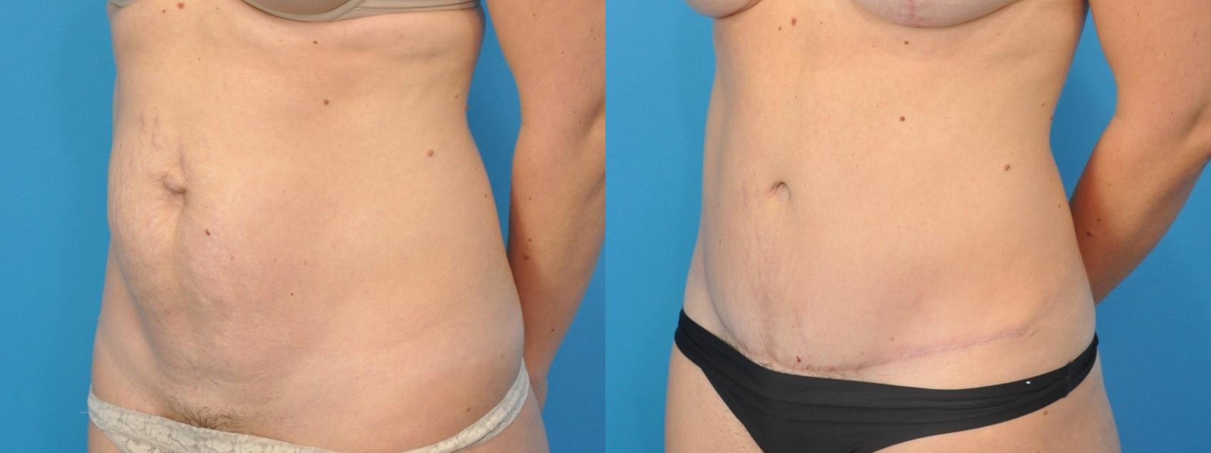 Before & After Abdominoplasty/Tummy Tuck Case 99 Left Oblique View in North Shore, IL