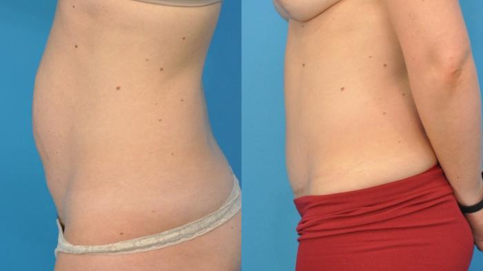 Before & After Abdominoplasty/Tummy Tuck Case 99 Left Side View in North Shore, IL