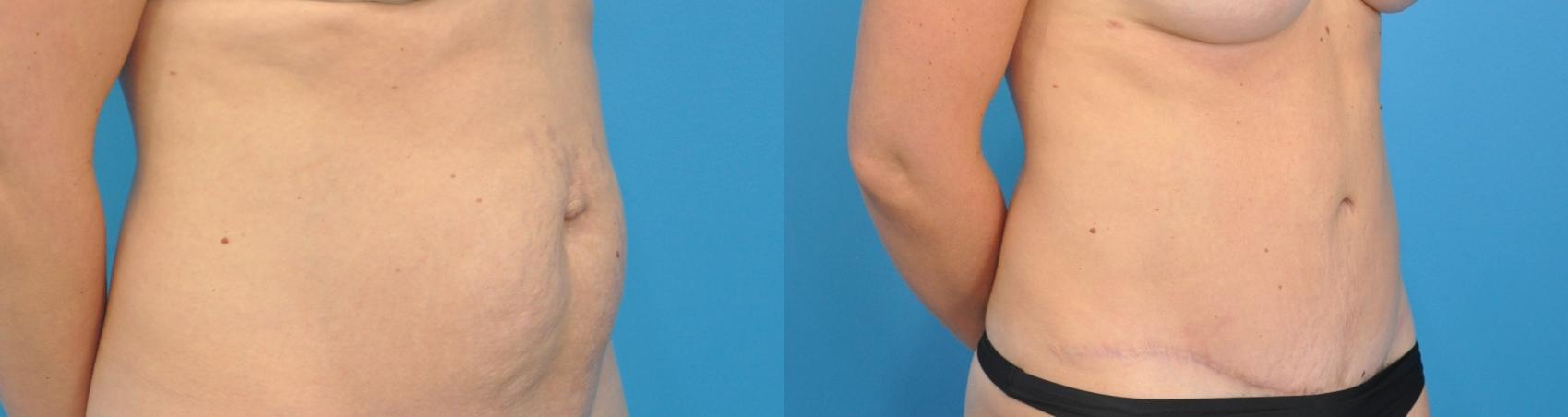 Before & After Abdominoplasty/Tummy Tuck Case 99 View #1 View in North Shore, IL