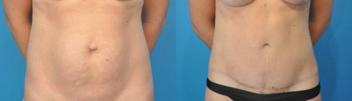 Before & After Abdominoplasty/Tummy Tuck Case 99 View #2 View in North Shore, IL
