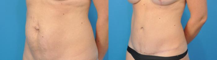 Before & After Abdominoplasty/Tummy Tuck Case 99 View #3 View in North Shore, IL