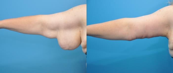 Before & After Arm Lift/ Brachioplasty Case 109 View #1 View in North Shore, IL