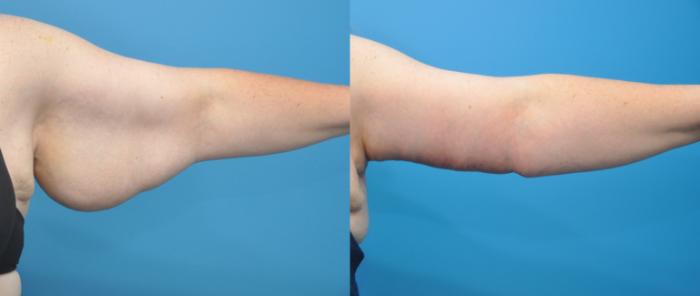 Before & After Arm Lift/ Brachioplasty Case 109 View #2 View in North Shore, IL