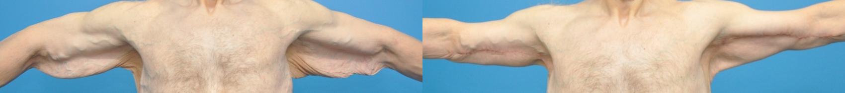 Before & After Arm Lift/ Brachioplasty Case 342 Front View in North Shore, IL