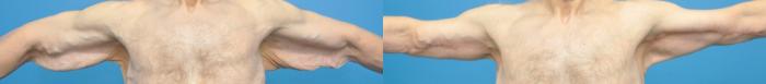 Before & After Arm Lift/ Brachioplasty Case 342 Front View in Northbrook, IL