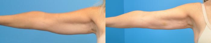 Before & After Arm Lift/ Brachioplasty Case 345 Front - Alt View in North Shore, IL