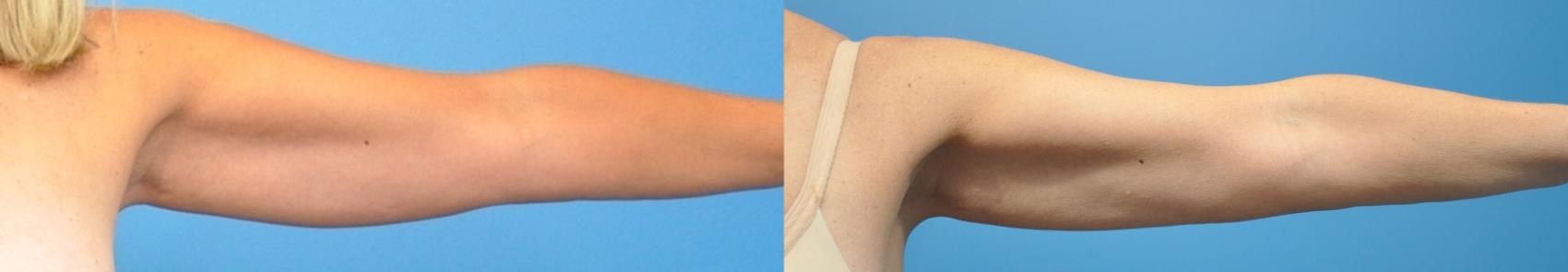 Before & After Arm Lift/ Brachioplasty Case 345 Front View in North Shore, IL