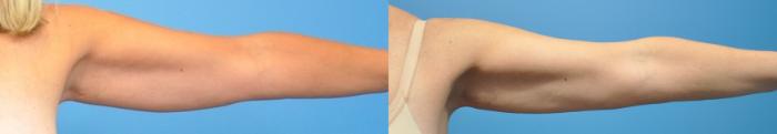 Before & After Arm Lift/ Brachioplasty Case 345 Front View in Northbrook, IL