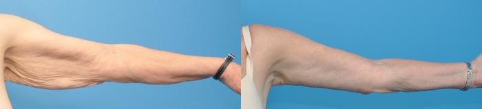 Before & After Arm Lift/ Brachioplasty Case 359 Front - Alt View in North Shore, IL
