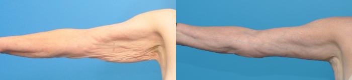 Before & After Arm Lift/ Brachioplasty Case 359 Front View in Northbrook, IL