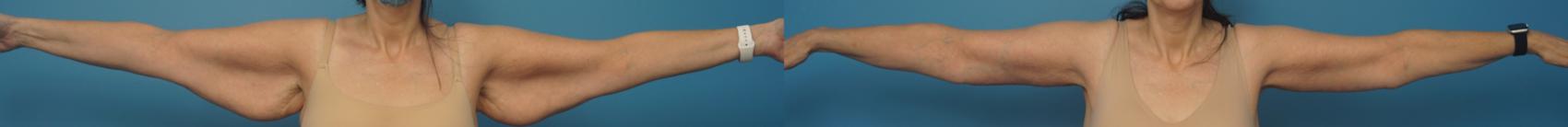Before & After Arm Lift/ Brachioplasty Case 407 Front View in North Shore, IL