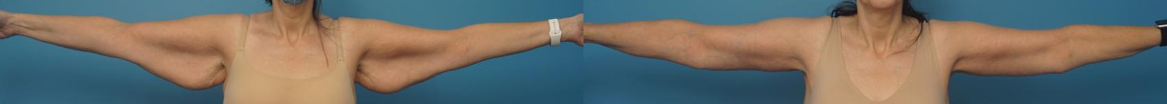 Before & After Arm Lift/ Brachioplasty Case 413 Front View in North Shore, IL