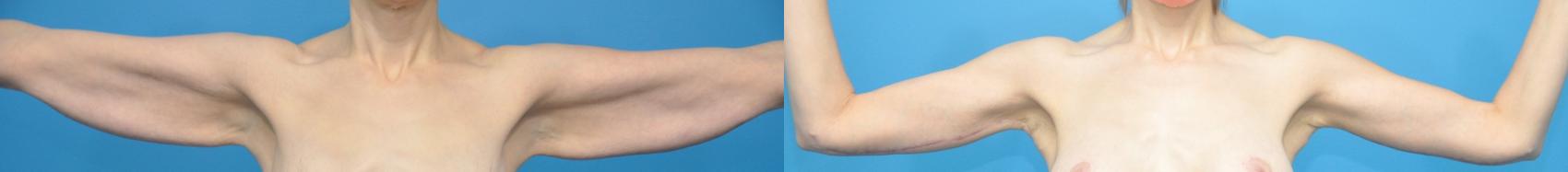Before & After Arm Lift/ Brachioplasty Case 432 Front View in North Shore, IL