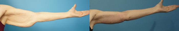 Before & After Arm Lift/ Brachioplasty Case 433 Front View in North Shore, IL