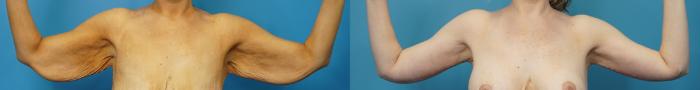 Before & After Arm Lift/ Brachioplasty Case 479 Front View in North Shore, IL