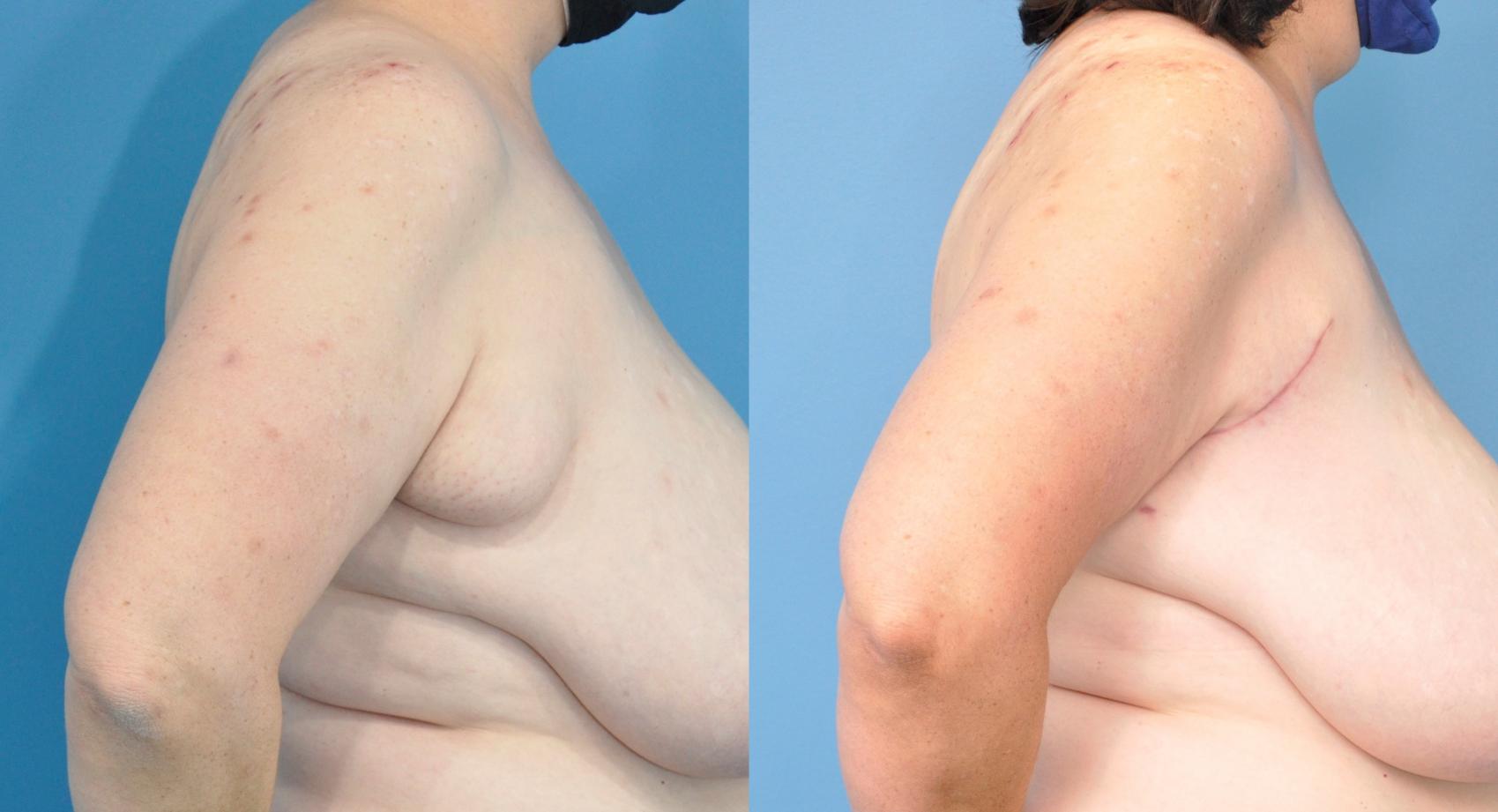 Before & After Axillary Breast Tissue Excision Case 224 View #1 View in Northbrook, IL