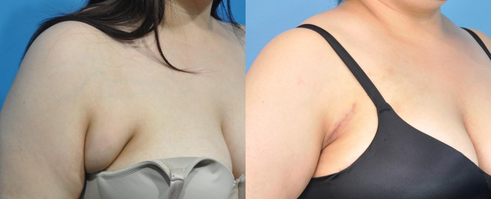 Before & After Axillary Breast Tissue Excision Case 229 View #1 View in Northbrook, IL