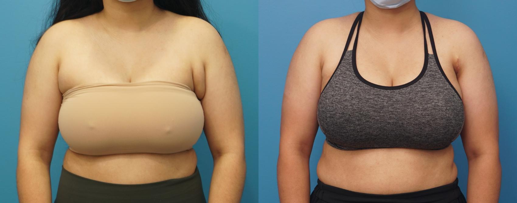 Before & After Axillary Breast Tissue Excision Case 321 Front View in Northbrook, IL