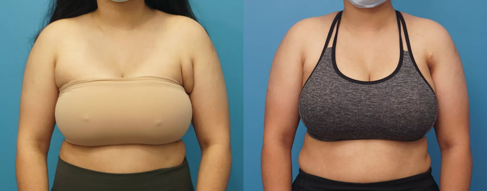 Axillary Breast Tissue Excision Before and After Pictures Case 321
