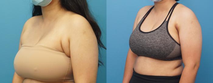 Before & After Axillary Breast Tissue Excision Case 321 Left Oblique View in Northbrook, IL