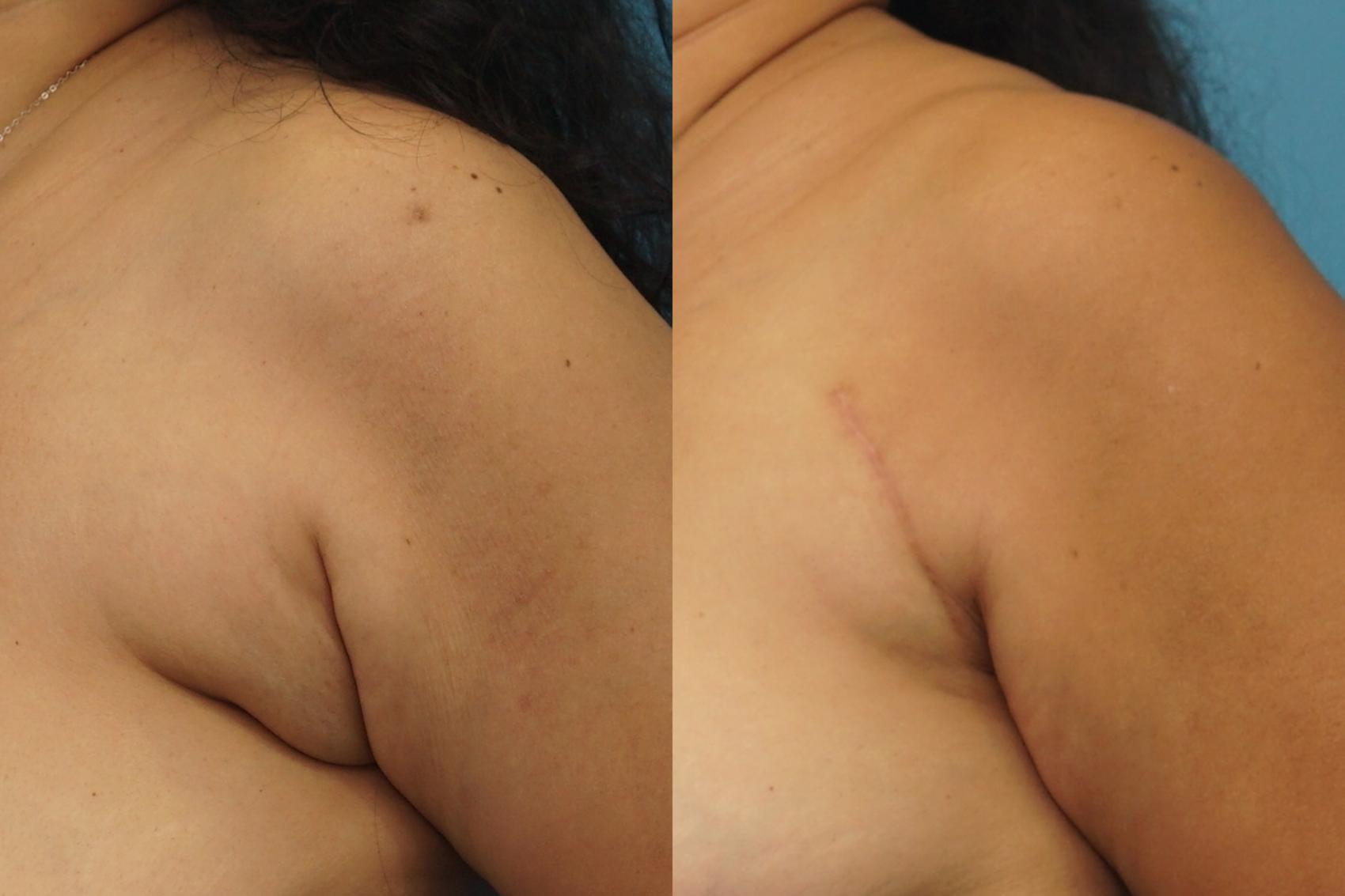 Before & After Axillary Breast Tissue Excision Case 450 Left Oblique View in North Shore, IL