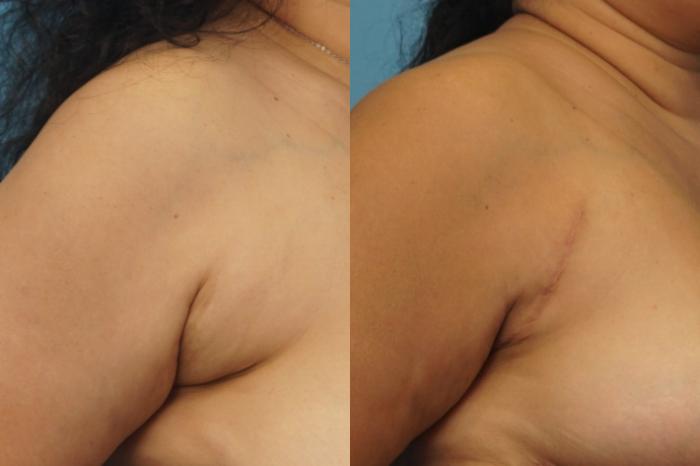 Before & After Axillary Breast Tissue Excision Case 450 Right Oblique View in North Shore, IL