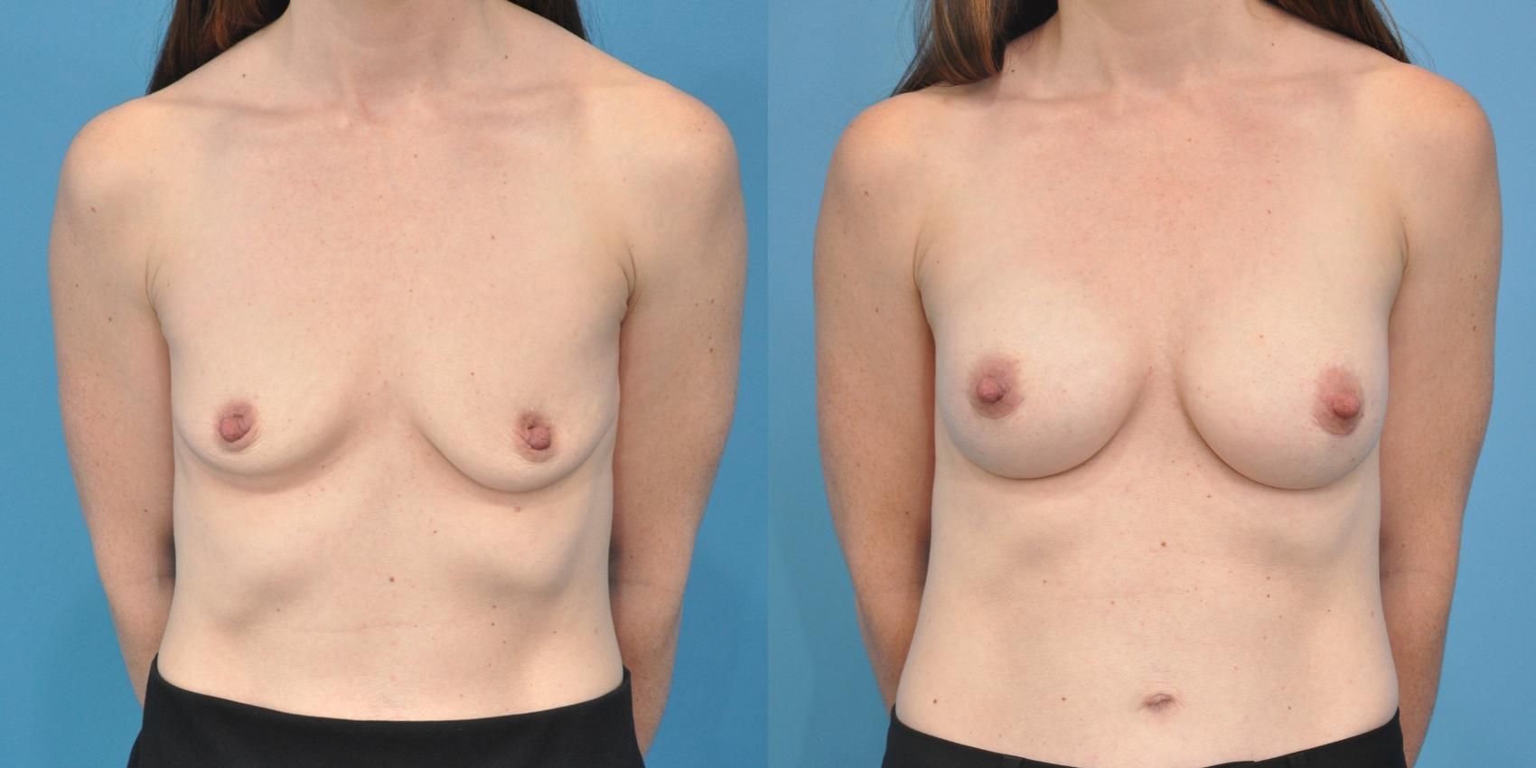 Before & After Breast Augmentation Case 107 View #1 View in Northbrook, IL