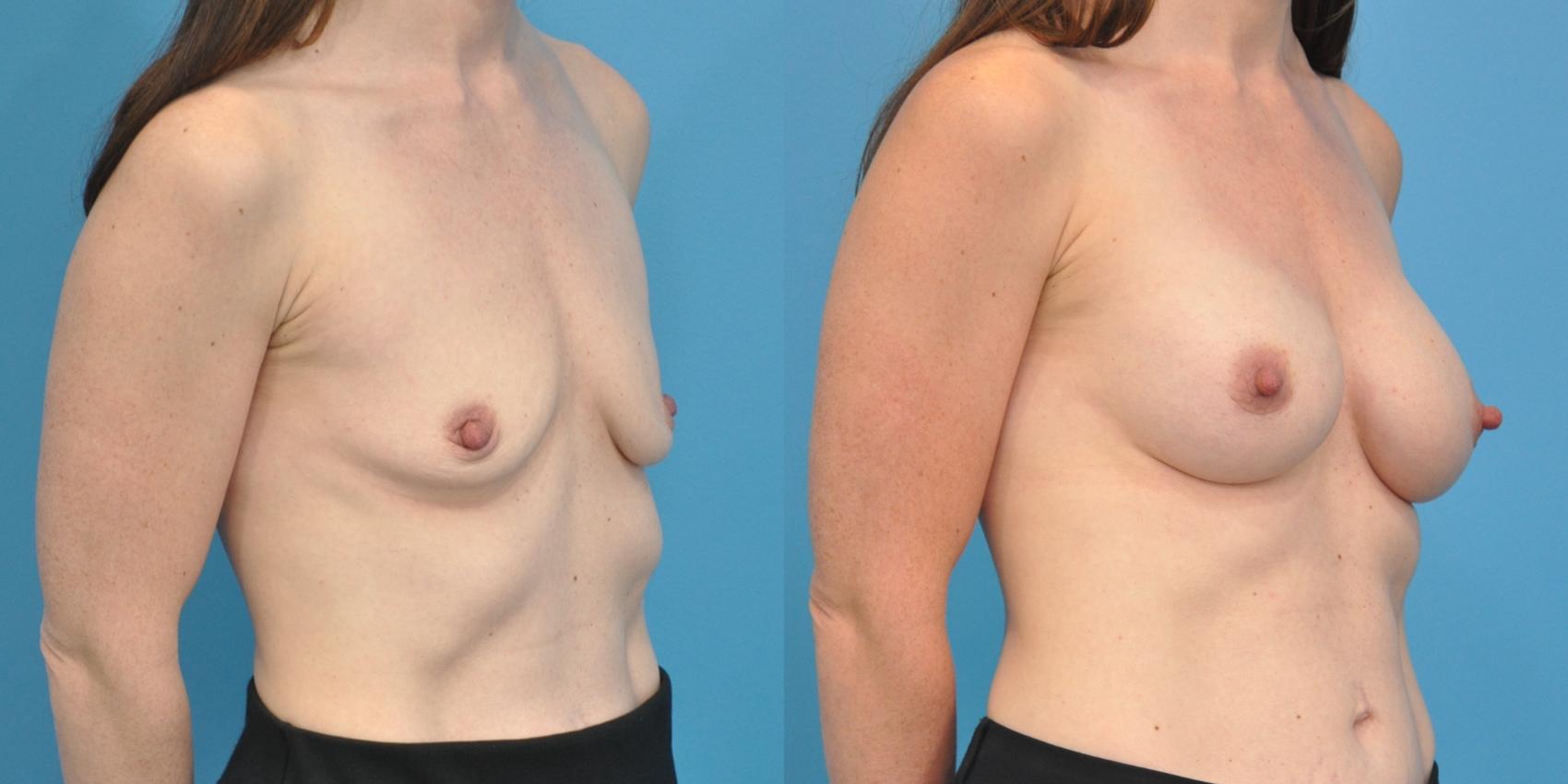 Before & After Breast Augmentation Case 107 View #2 View in Northbrook, IL