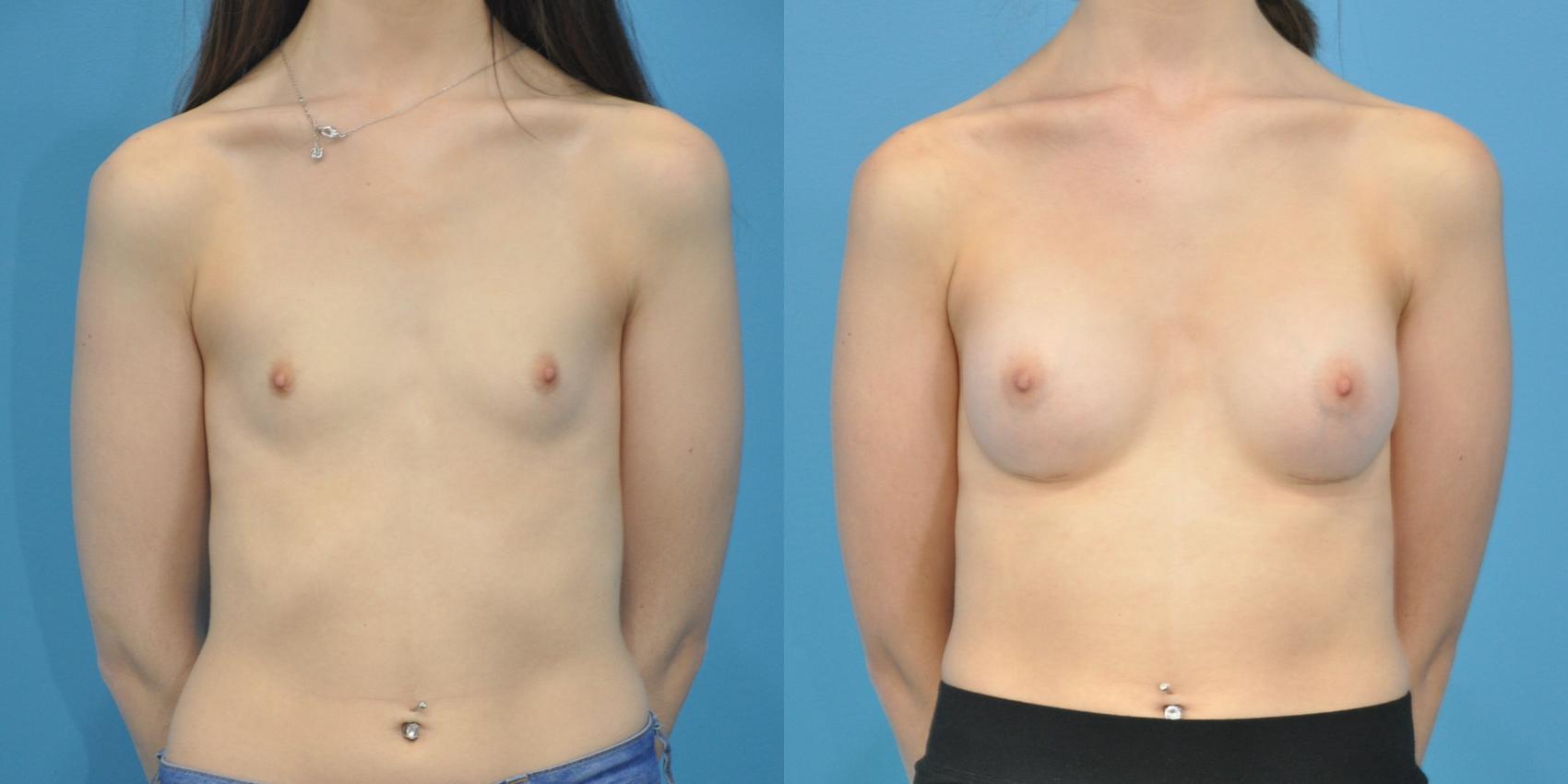 Before & After Breast Augmentation Case 110 View #1 View in North Shore, IL