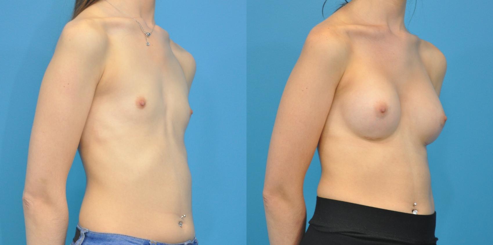 Before & After Breast Augmentation Case 110 View #2 View in Northbrook, IL