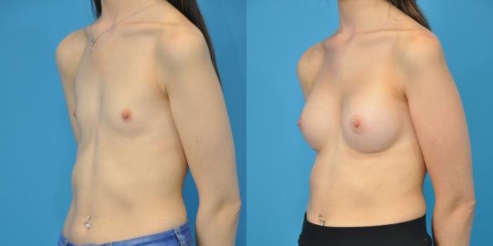 Before & After Breast Augmentation Case 110 View #3 View in Northbrook, IL