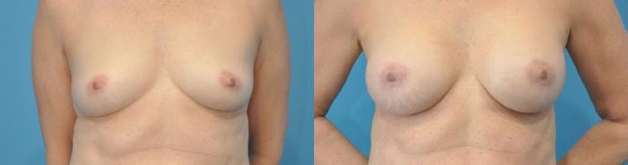 Before & After Breast Augmentation Case 115 View #1 View in Northbrook, IL
