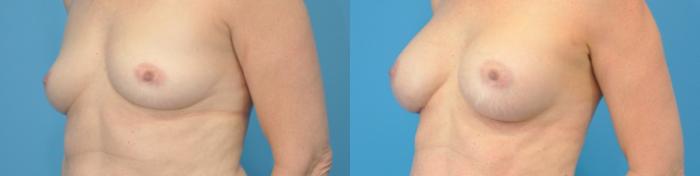 Before & After Breast Augmentation Case 115 View #3 View in North Shore, IL