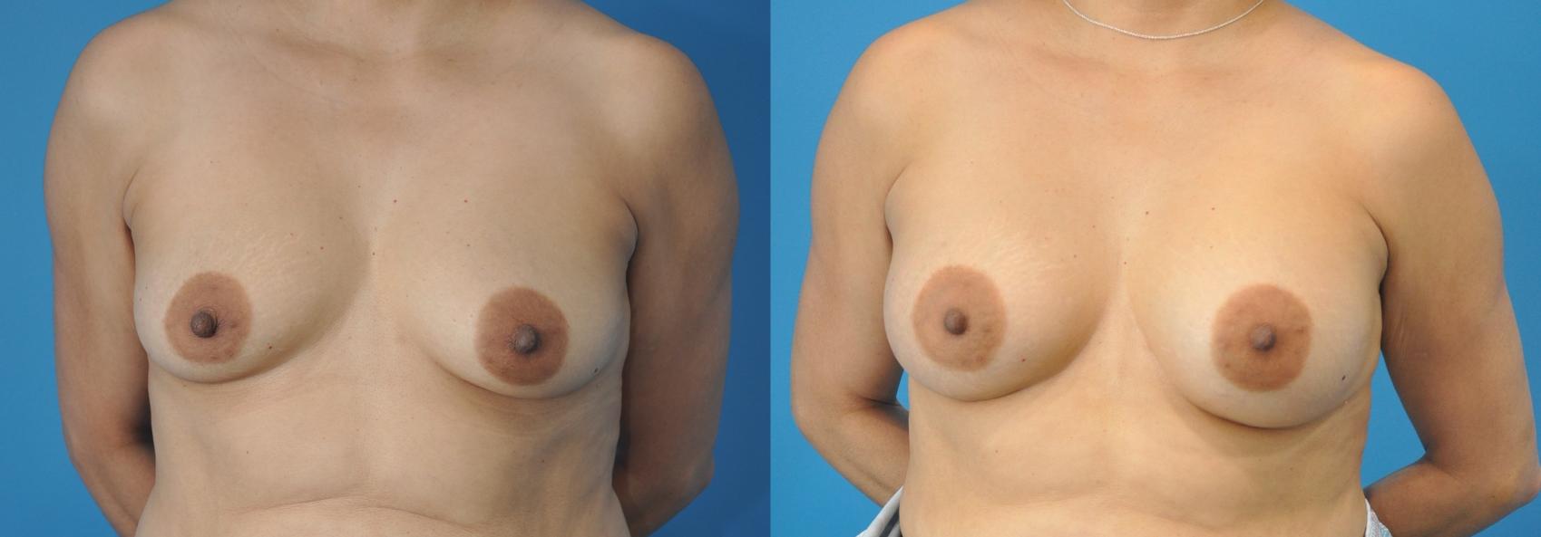 Before & After Breast Augmentation Case 135 View #1 View in Northbrook, IL
