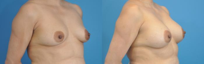 Before & After Breast Augmentation Case 135 View #2 View in Northbrook, IL