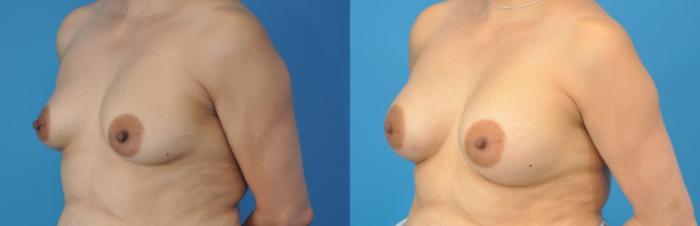 Before & After Breast Augmentation Case 135 View #3 View in Northbrook, IL