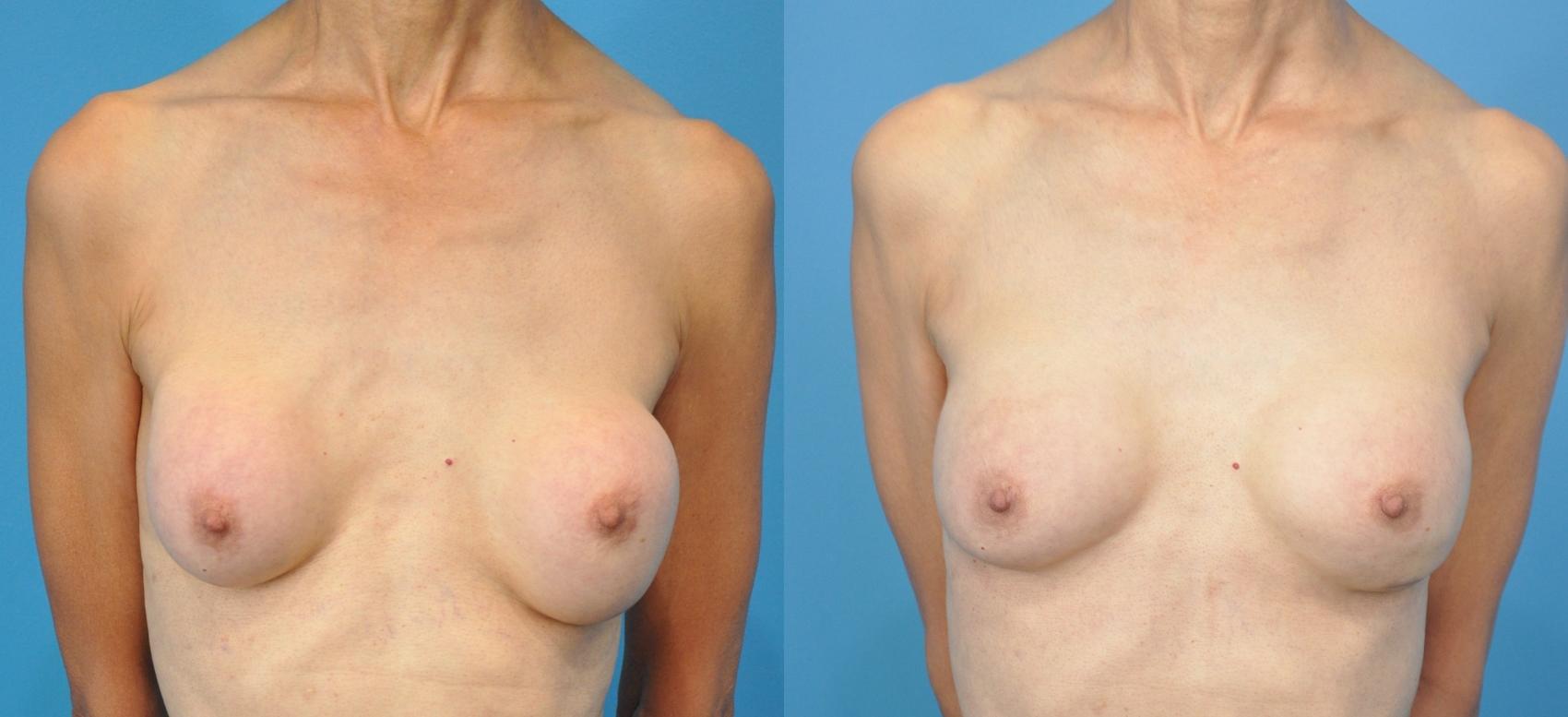 Before & After Breast Augmentation Case 140 View #1 View in Northbrook, IL