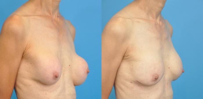 Before & After Breast Augmentation Case 140 View #2 View in Northbrook, IL