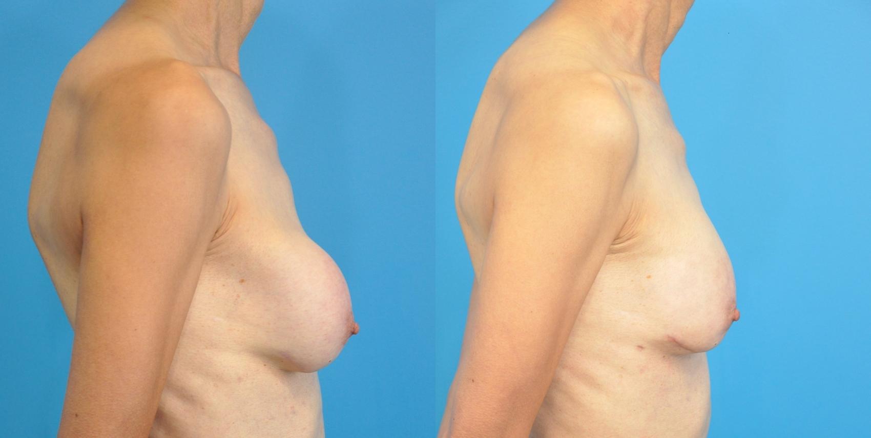 Before & After Breast Augmentation Case 140 View #3 View in Northbrook, IL