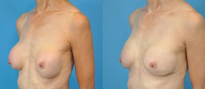 Before & After Breast Augmentation Case 140 View #4 View in Northbrook, IL