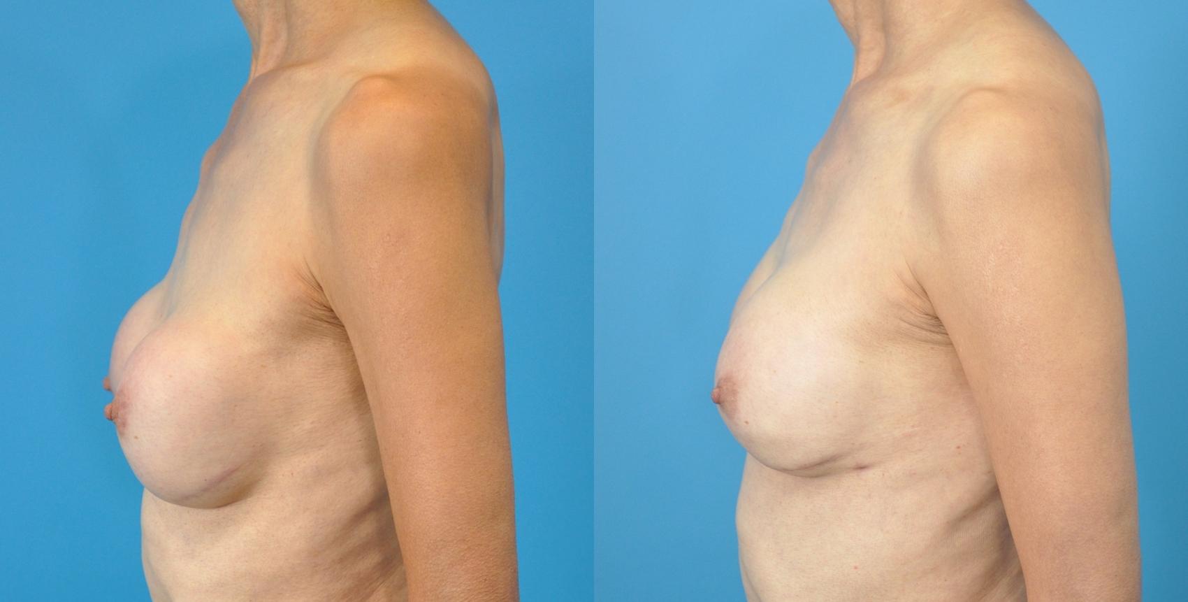 Before & After Breast Augmentation Case 140 View #5 View in Northbrook, IL