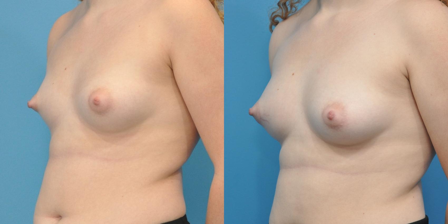 Before & After Breast Augmentation Case 152 View #1 View in North Shore, IL