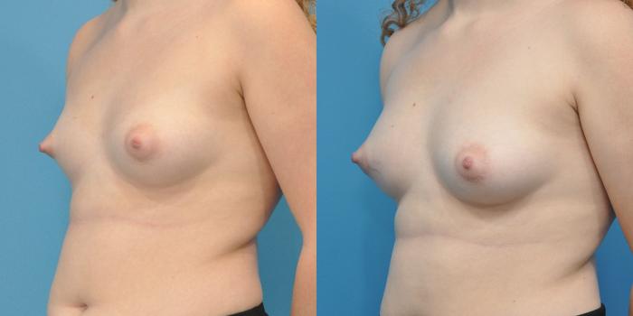 Before & After Breast Augmentation Case 152 View #1 View in Northbrook, IL