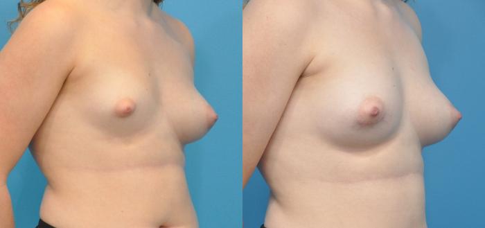 Before & After Breast Augmentation Case 152 View #2 View in North Shore, IL