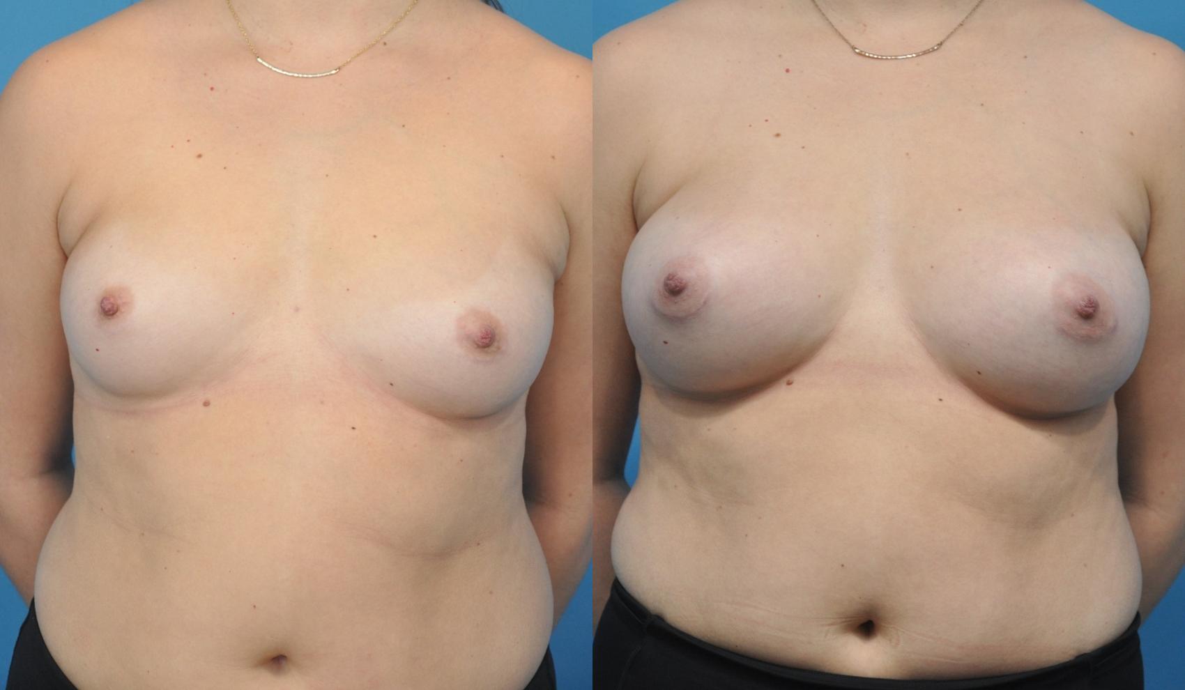 Before & After Breast Augmentation Case 158 View #1 View in Northbrook, IL