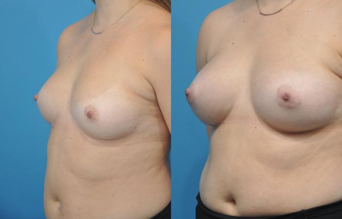 Before & After Breast Augmentation Case 158 View #2 View in North Shore, IL