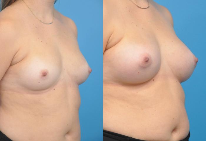 Before & After Breast Augmentation Case 158 View #3 View in North Shore, IL