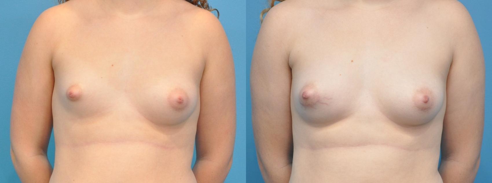 Before & After Breast Augmentation Case 169 View #1 View in Northbrook, IL