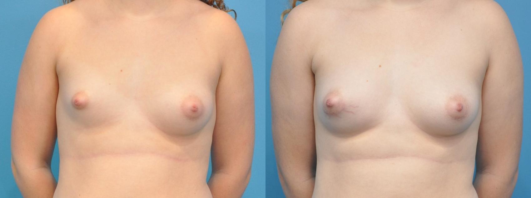 Before & After Breast Augmentation Case 169 View #1 View in North Shore, IL